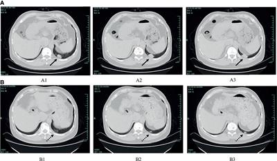 Case Report: A Case of Sintilimab-Induced Cystitis/Ureteritis and Review of Sintilimab-Related Adverse Events